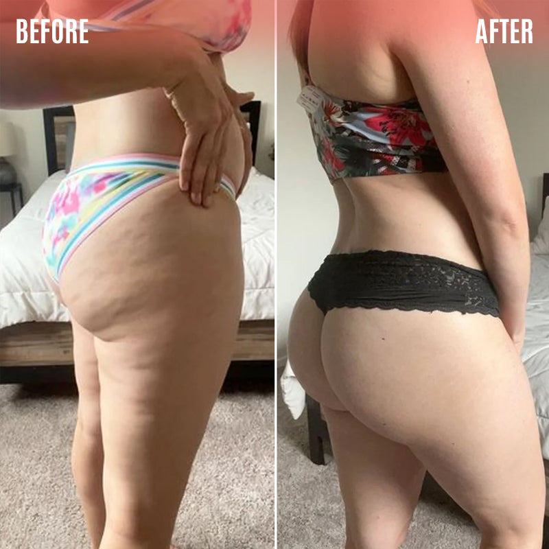 With losing and gaining weight over the years, my legs started to get a lot of cellulite marks and my butt started to sag. I decided to try MiaBody to help me and see my results. My buttocks looks rounder and firmer. Marks are less visible than before. I would recommend this device to anyone I know.