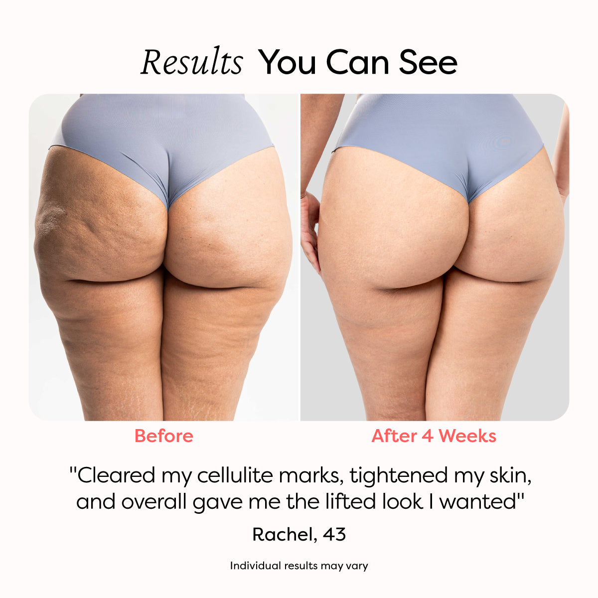 A side-by-side comparison of a woman's lower body before and after using the MiaBody device for 4 weeks. The left side shows visible cellulite marks, while the right side displays smoother skin. A quote from Rachel, 43, highlights her satisfaction: 'Cleared my cellulite marks, tightened my skin, and overall gave me the lifted look I wanted.' The image emphasizes the effectiveness of the treatment.